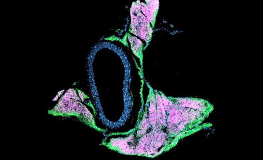 উচ্চ রক্তচাপের নতুন চিকিৎসা 